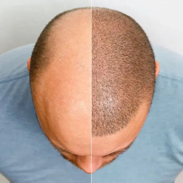 Alopeciatratamiento