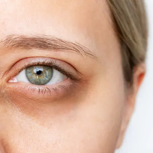 Ojeras