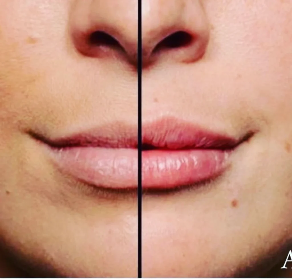 labios 10