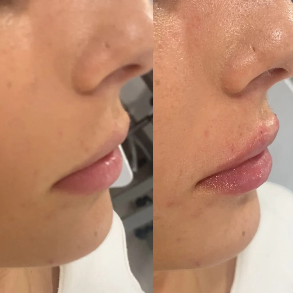 labios11