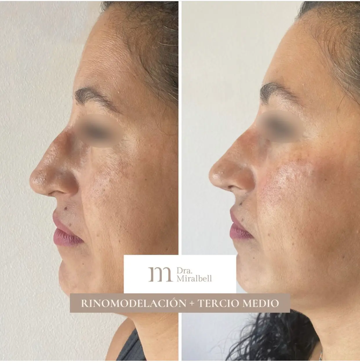 profiloplastia 2