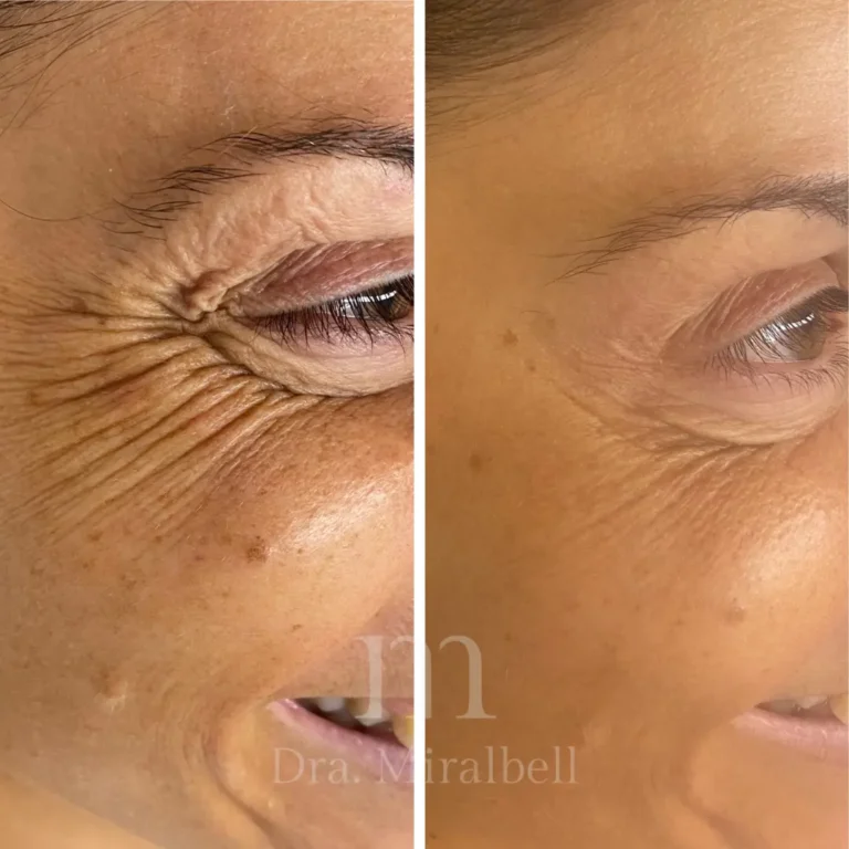neuromoduladores (botox)3