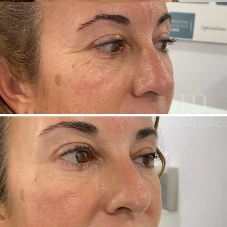 neuromoduladores(botox)