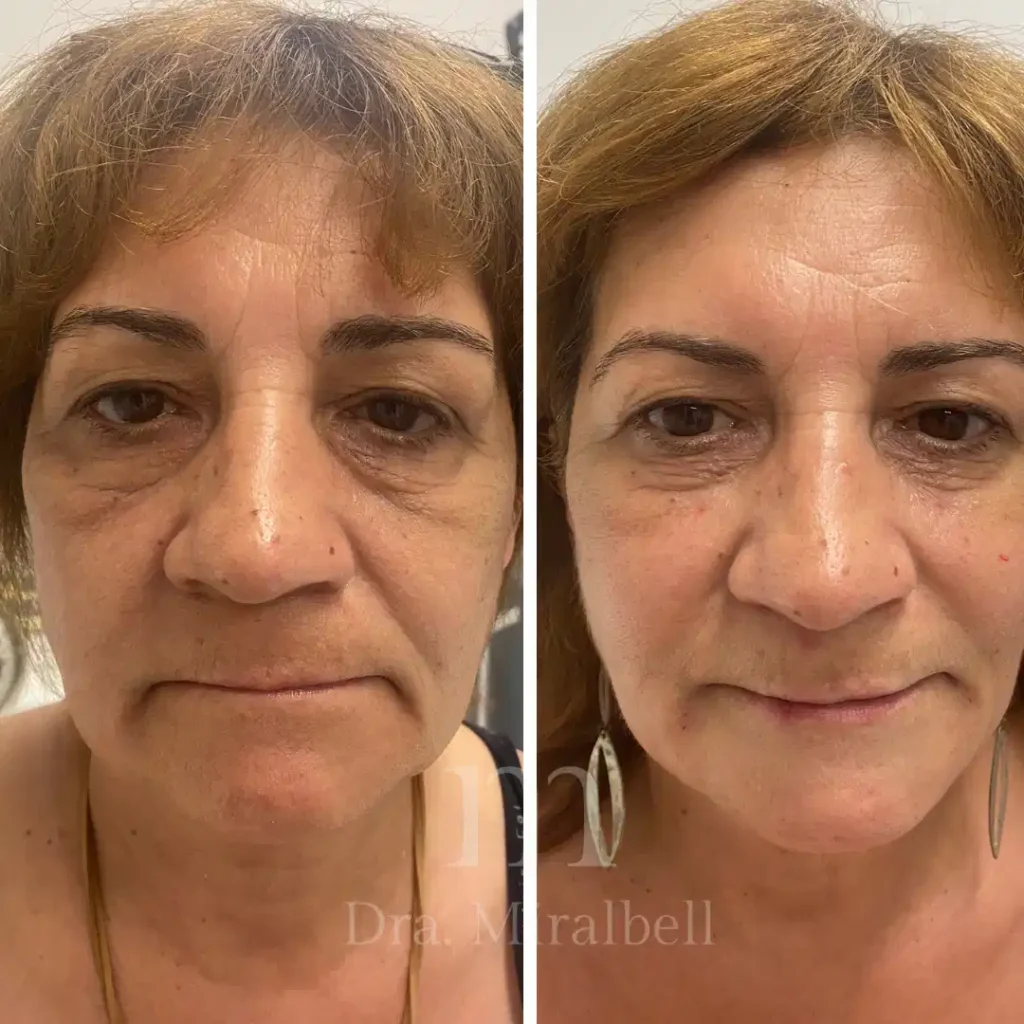 Rejuvenecimiento facial