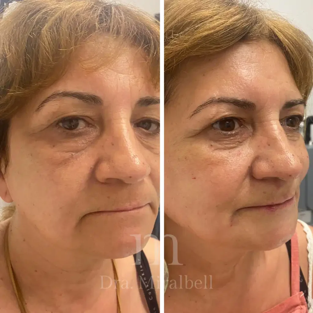 Rejuvenecimiento facial