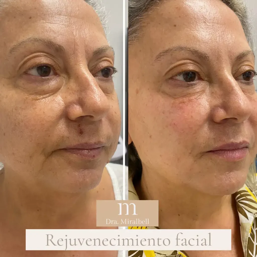 revuvenecimiento facial